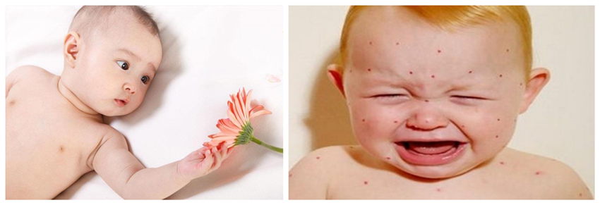 兒童濕疹反反複複，您有在家安裝家用除濕產品嗎？